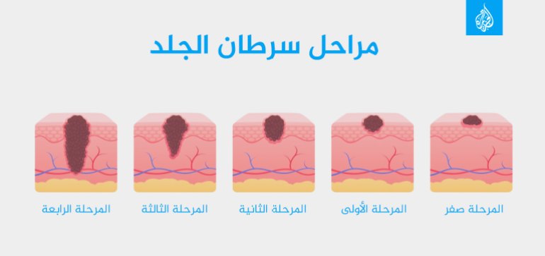 مراحل سرطان الجلد